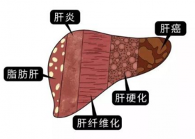 为什么肝癌发现就是晚期？养肝护肝刻不容缓，哪些伤肝行为你还在做？